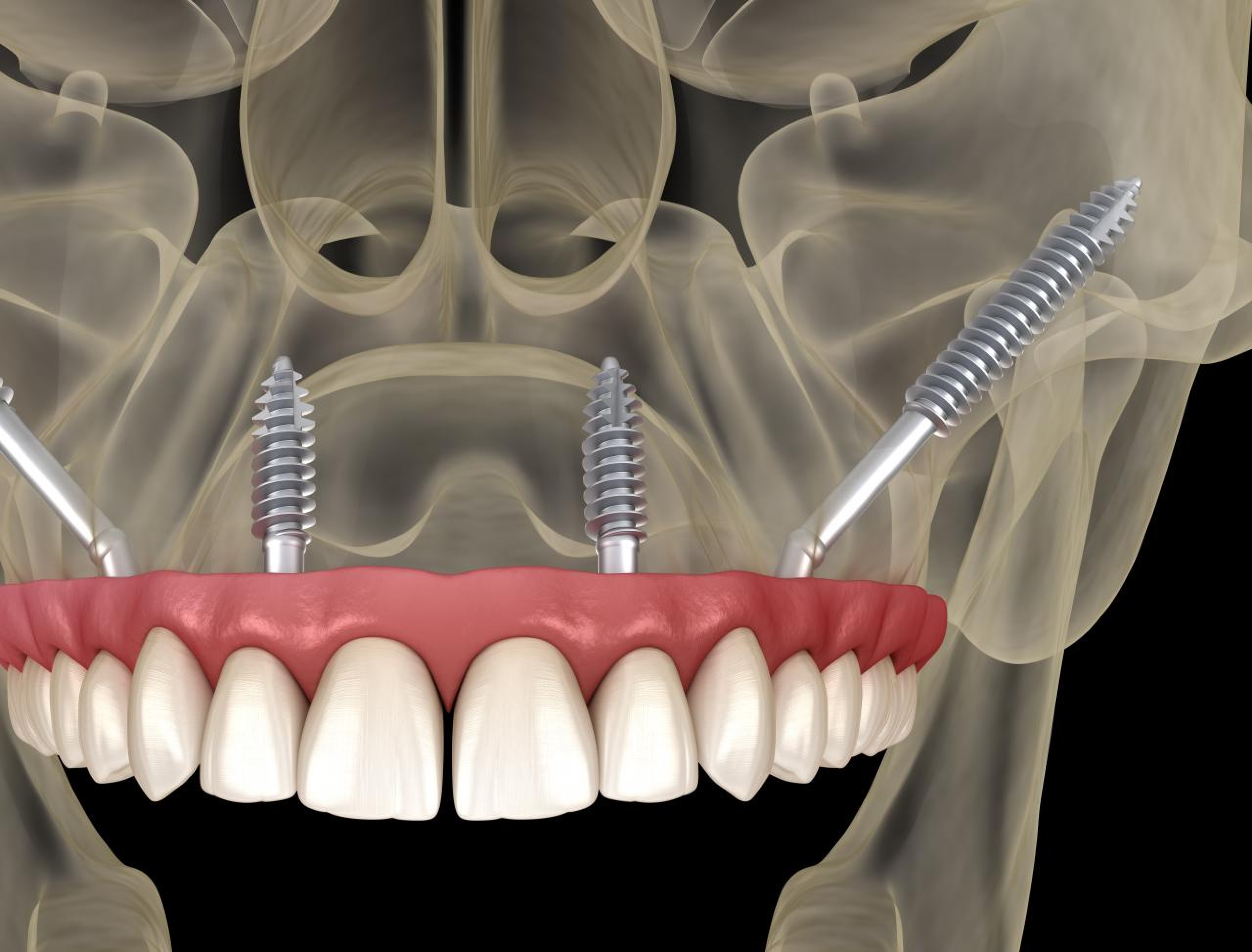 Implantet dentare për personat me pak kockë