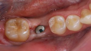 Understanding the sources of discomfort can help you prepare and manage expectations. Surgical trauma is the primary cause of post-op pain. This includes minor damage to soft tissue and jawbone during implant placement.