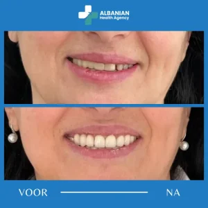 Tanden bleken in Albanië