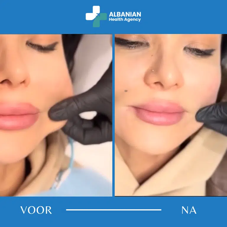 Botox en niet-chirurgisch