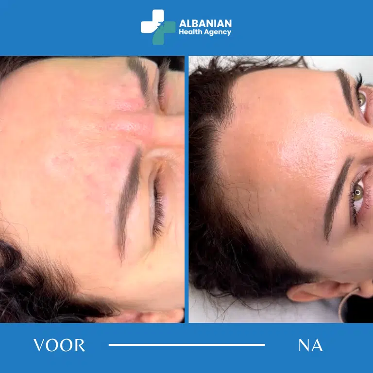 Esthetische behandelingen in Albanië