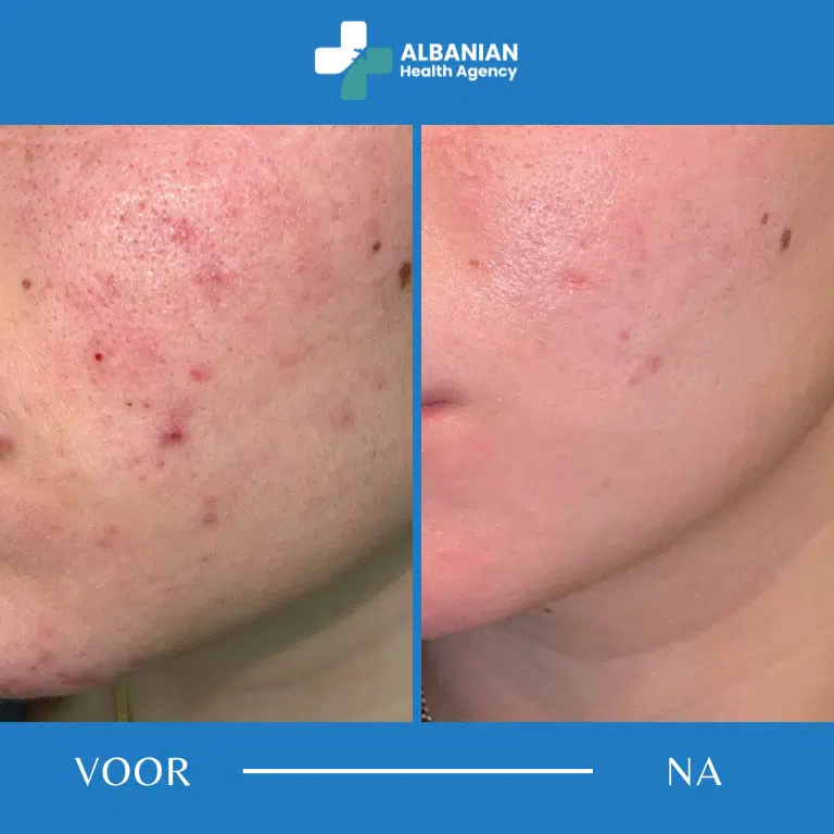 Huidverjonging