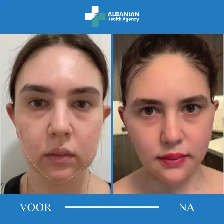 Kaaklijn- en wangcontouring