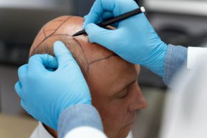 Read how does a hair transplant work—step by step. Learn about techniques, recovery, costs, and why Albania offers top-quality.