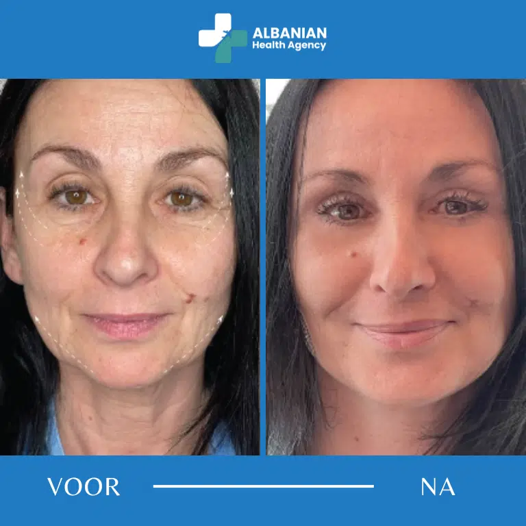 Oog- en wenkbrauwchirurgie in Albanië