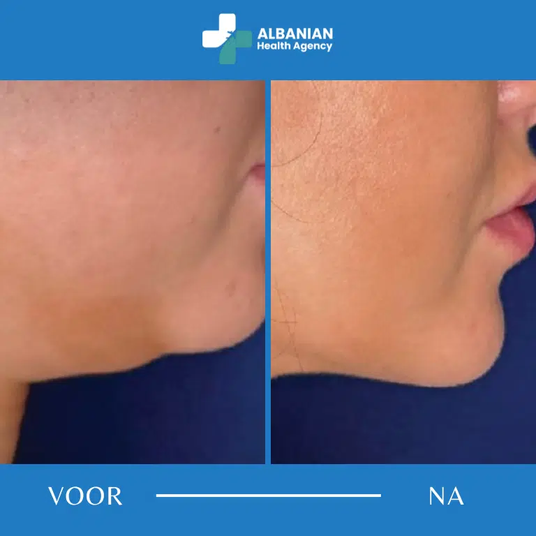 Kaaklijn- en wangcontouring