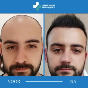 Haartransplantatie met DHI