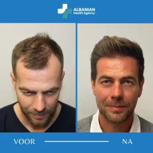 Haartransplantatie met DHI