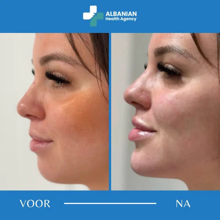 Gezichtscontouring