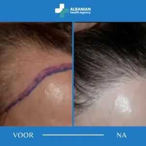Haartransplantatie Vrouwen Albanië