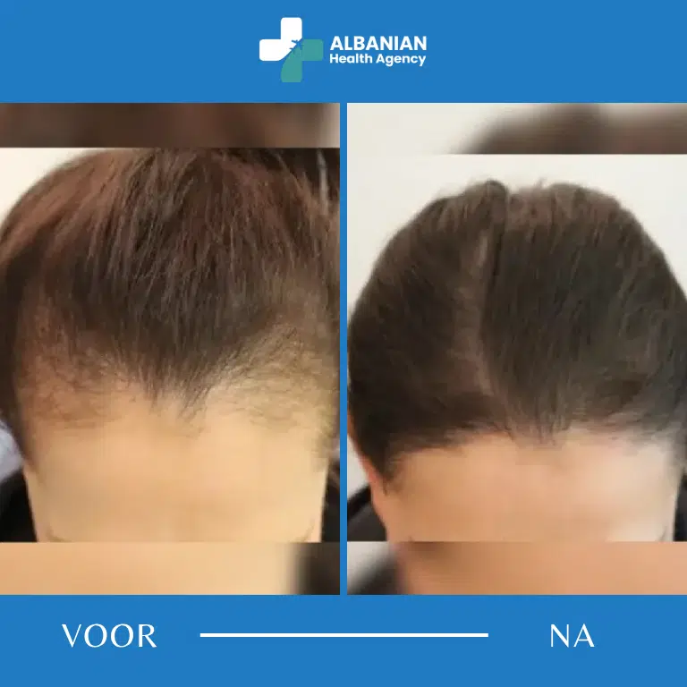 Haartransplantatie Vrouwen Albanië