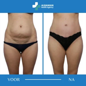 Lichaamschirurgie in Albanië