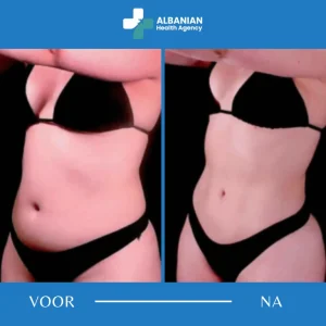 Lichaamschirurgie in Albanië