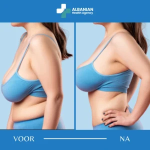 Borstchirurgie in Albanië