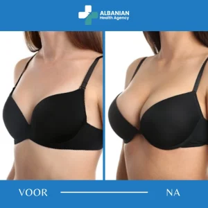 Borstchirurgie in Albanië