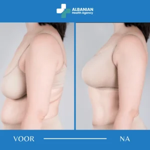 Borstchirurgie in Albanië