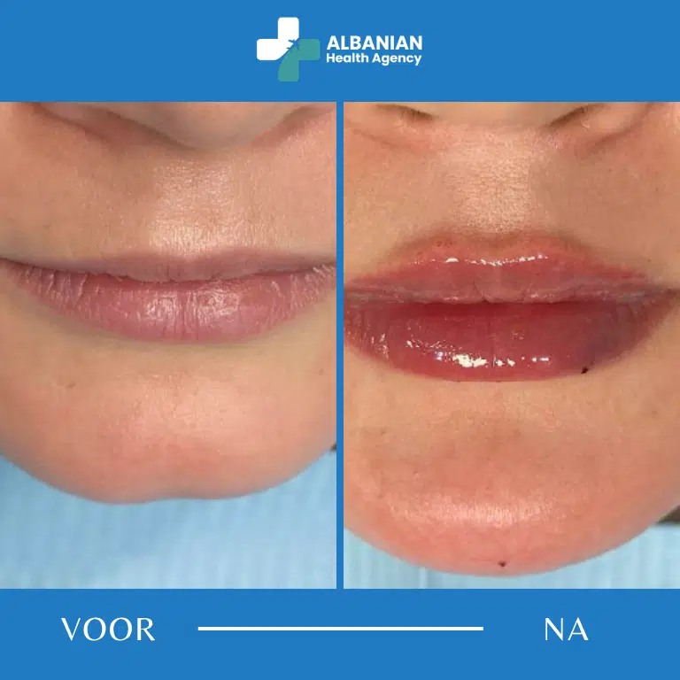Lip- en rimpelbehandelingen