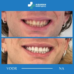 Tanden bleken in Albanië