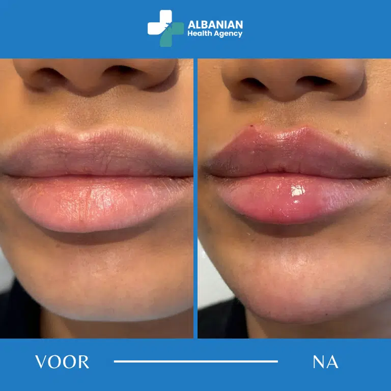 Lip- en rimpelbehandelingen