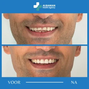 Tandkronen in Albanië