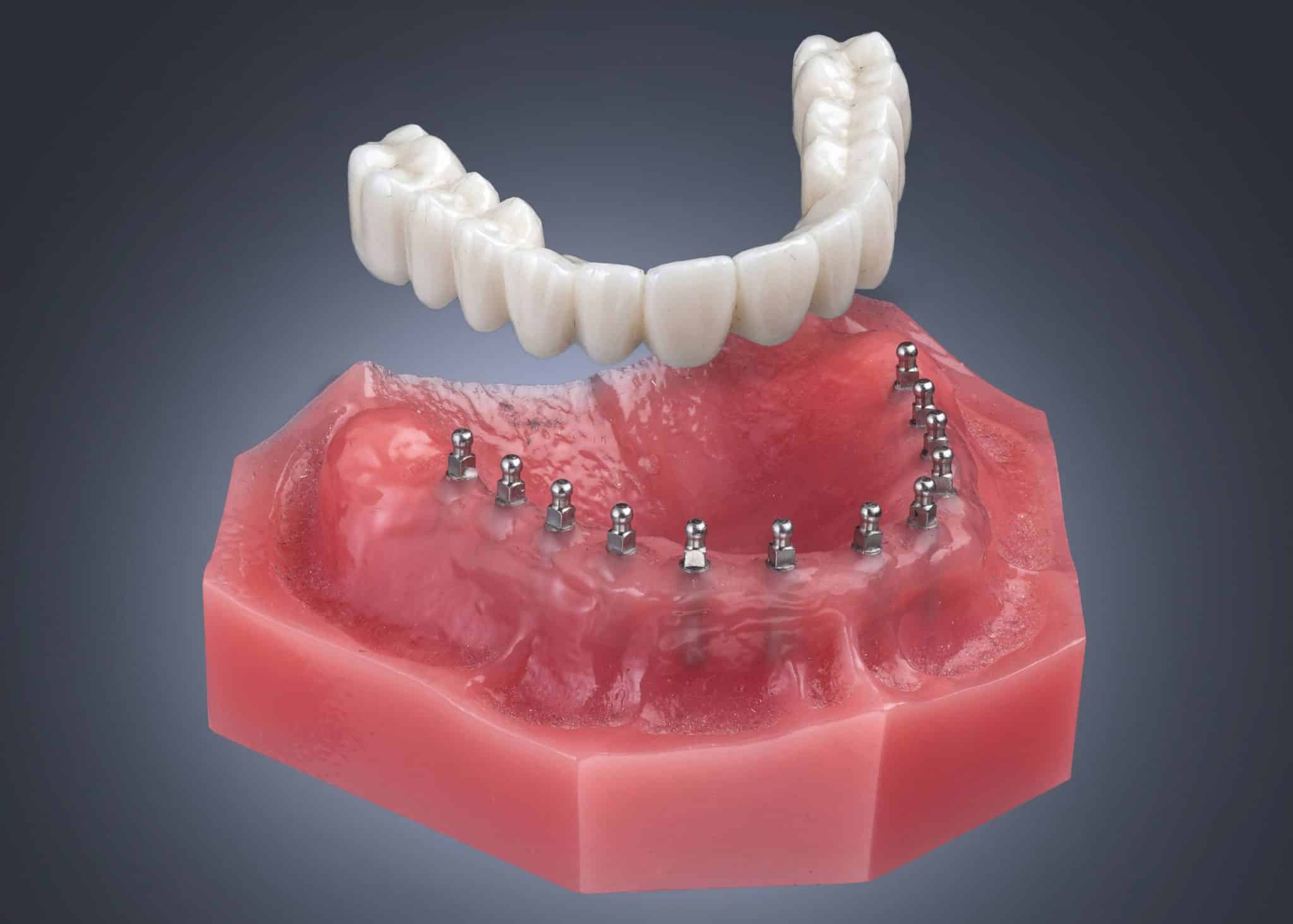 Scopri i migliori impianti dentali al mondo, le marche più affidabili e le destinazioni ideali per l'implantologia. Una guida dettagliata.