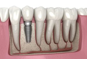 Wondering what are the 3 types of dental implants? Discover the differences, advantages, and expert advice in this comprehensive 2025 guide.