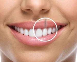 Scopri come capire se un impianto dentale ha fatto infezione. Sintomi, cause, trattamenti e consigli da esperti per prevenire complicazioni.