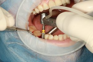 One of the most reassuring facts is that dental implant placement is not painful during the surgery. Dentists use local anesthesia to numb the treatment area completely. This ensures that patients feel no pain while the titanium implant is being placed into the jawbone.