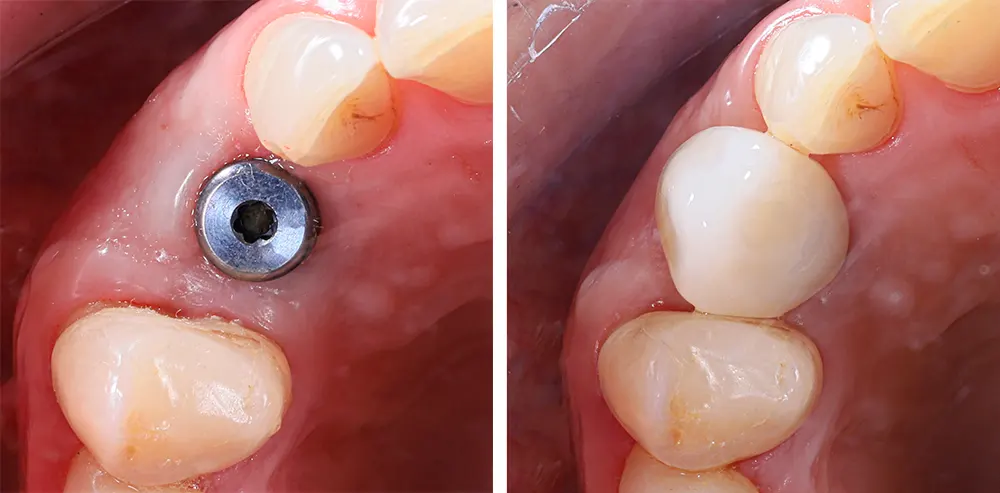 Discover how dental implants are changing the dental industry in 2025. Learn about new technologies, global trends, and what this means.