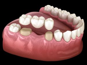 Can you put a dental bridge after a crown? Learn everything about the process, expert advice, and what to expect.