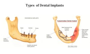 What are the 3 types of dental implants? Discover detailed differences, expert advice, and why Albania is a top destination for implants.
