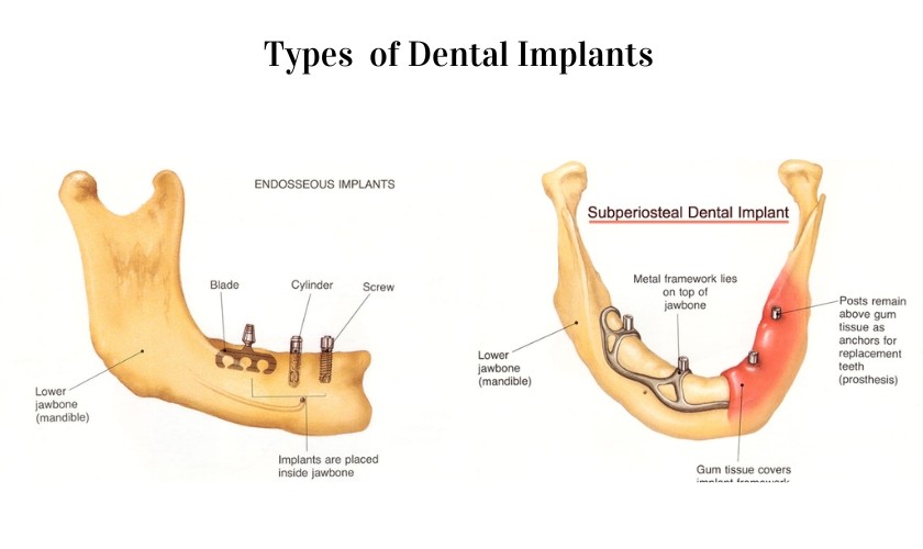 What are the 3 types of dental implants? Discover detailed differences, expert advice, and why Albania is a top destination for implants.
