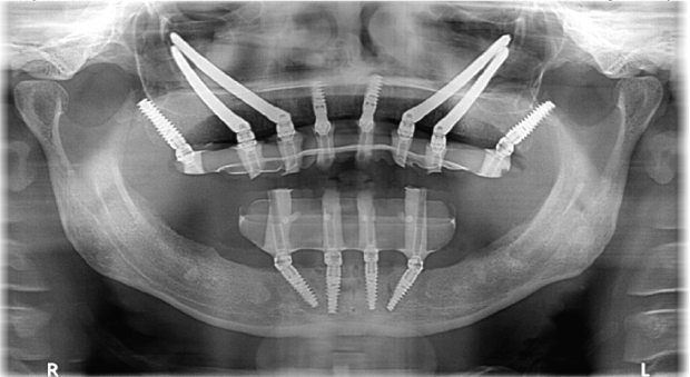 What are the 3 types of dental implants? Discover detailed differences, expert advice, and why Albania is a top destination for implants.
