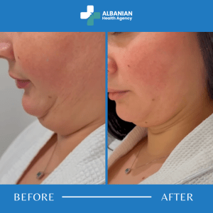 Double Chin Liposuction