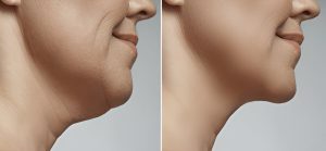 Double Chin Liposuction
