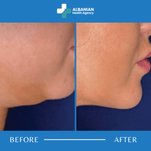 Double Chin Liposuction