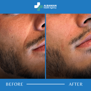 Nasolabial Fold Filler