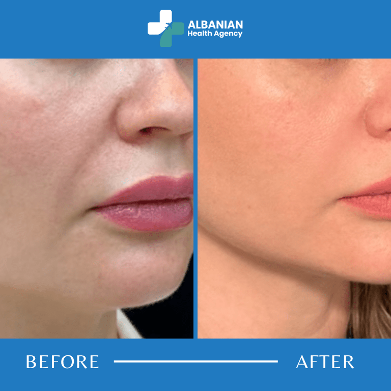 Nasolabial Fold Filler