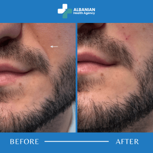 Nasolabial Fold Filler