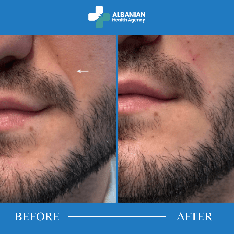 Nasolabial Fold Filler