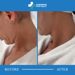 Double Chin Liposuction