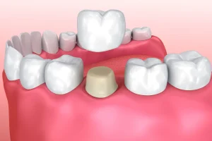 Scopri la differenza tra corone ceramiche vs corone in zirconio. Confronto dettagliato tra estetica, durata, costi e applicazioni.