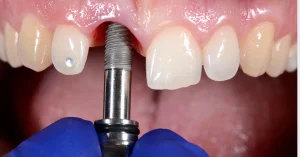 Albania’s dental tourism market has grown exponentially. With modern clinics, English-speaking dentists, and internationally trained specialists, the country now rivals traditional hubs like Turkey. The Albanian Health Agency connects patients with top-rated clinics in Tirana, Durres, and Vlore—ensuring quality, transparency, and patient satisfaction. Discover why Albania may be a better choice than Turkey for high-quality, dental implants.