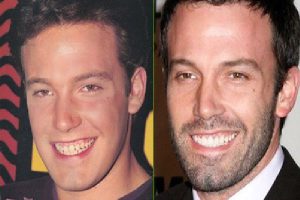 Uno sguardo chiaro e documentato al makeover dentale di Ben Affleck prima di Armageddon: cosa è certo, cosa è plausibile, e come Hollywood modella i suoi protagonisti.