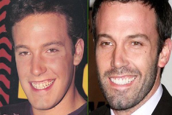 Discover the story of Ben Affleck’s teeth transformation. From early dental work before Armageddon to Hollywood’s obsession.