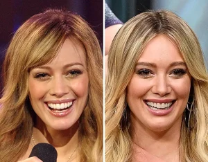 Le faccette dentali di Hilary Duff: scopri la vera storia dietro il suo sorriso trasformato dopo una scheggiatura dentale.