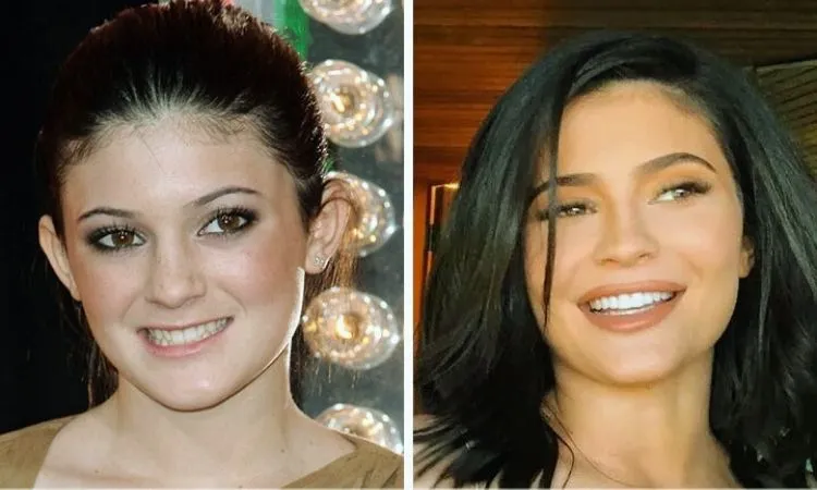Kylie Jenner teeth transformation explained — what’s natural, what’s cosmetic, and what her smile evolution teaches about modern dentistry