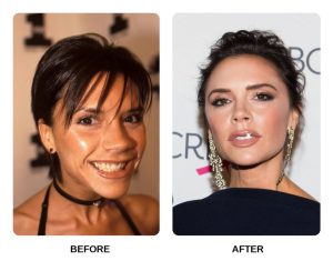 Discover the evolution of Victoria Beckham’s teeth, from the Spice Girls era to her refined, natural smile we see today.
