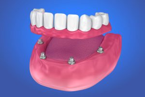 What is the best age to get dental implants? Discover the ideal age range, the minimum requirements, and why health and bone quality matter more than age for long-term implant success.