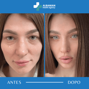 Prima e dopo trattamento estetico – Albanian Health Agency
